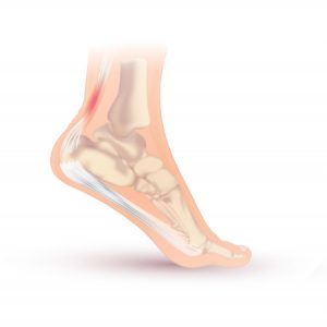Severs disease is a common overuse injury in athletes