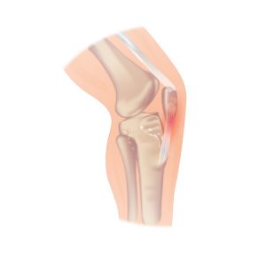 OSD a common overuse injury in athletes
